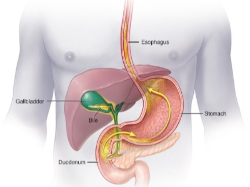 علل و علائم رفلاکس صفرا و نحوه درمان آن