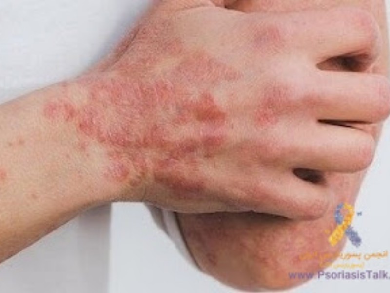 چگونه با تغذیه سالم به کنترل علائم بیماری برسید