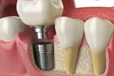 دوره مهارتی ایمپلنت در ایلام آغاز شد