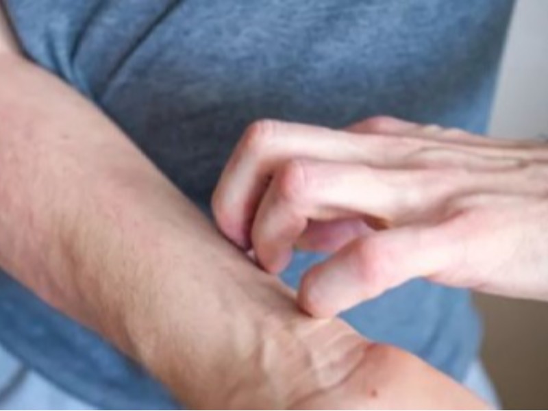 علائم حساسیت پوستی به داروها علائم حساسیت پوستی به داروها
